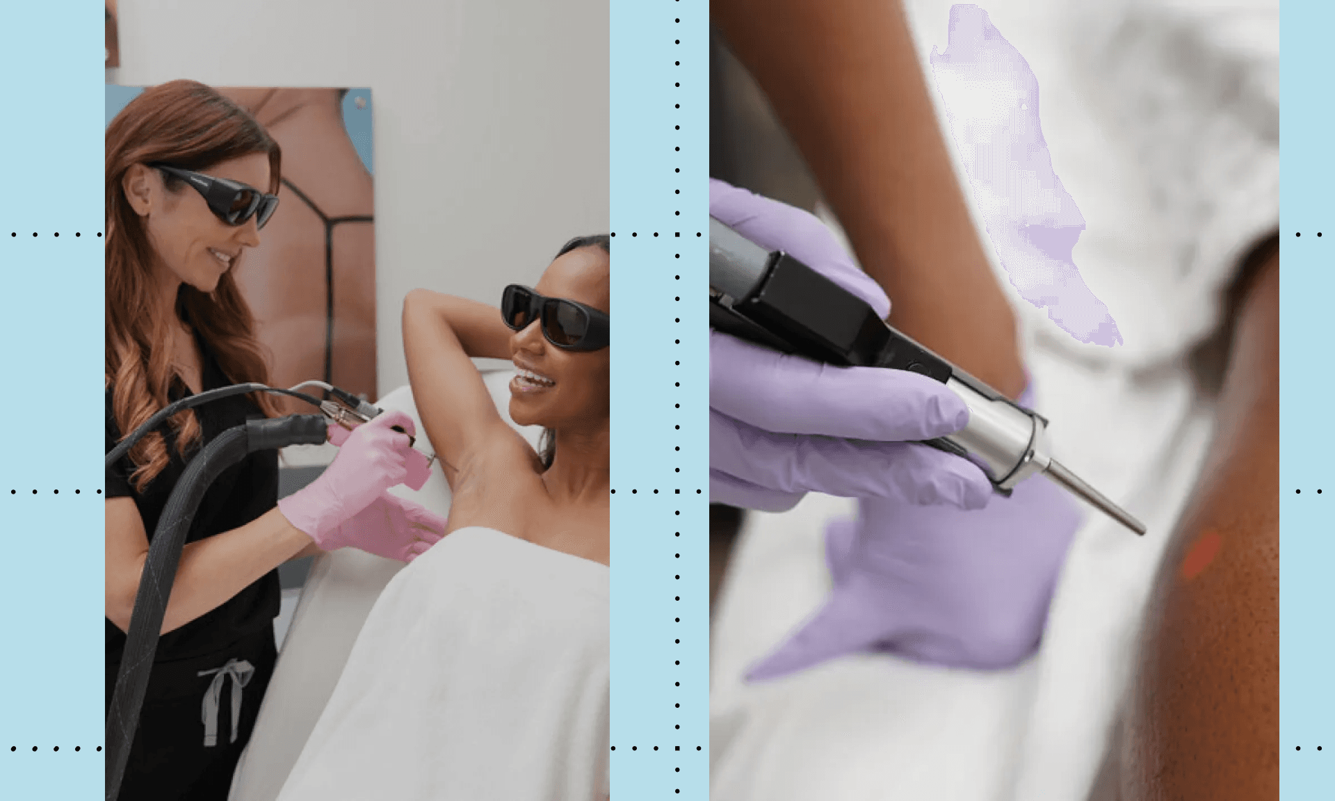 laseraway laser hair removal review